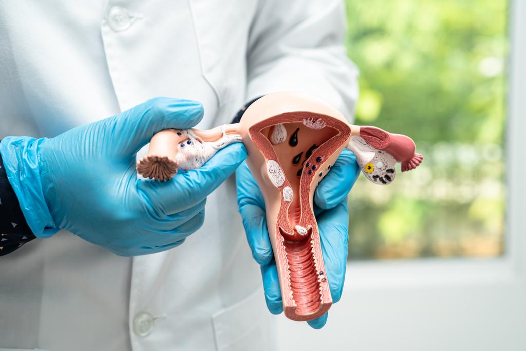 Kista Ovarium  Penyebab Gejala dan Kapan Harus ke Dokter