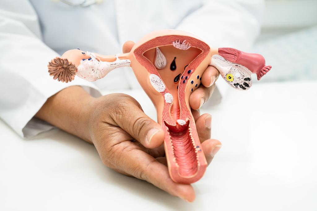 Miom  Penyebab Gejala dan Kapan Harus ke Dokter