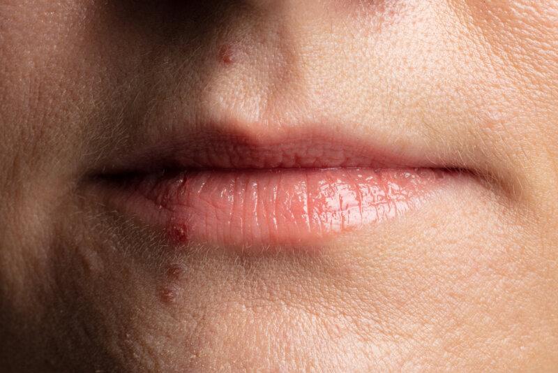 Herpes