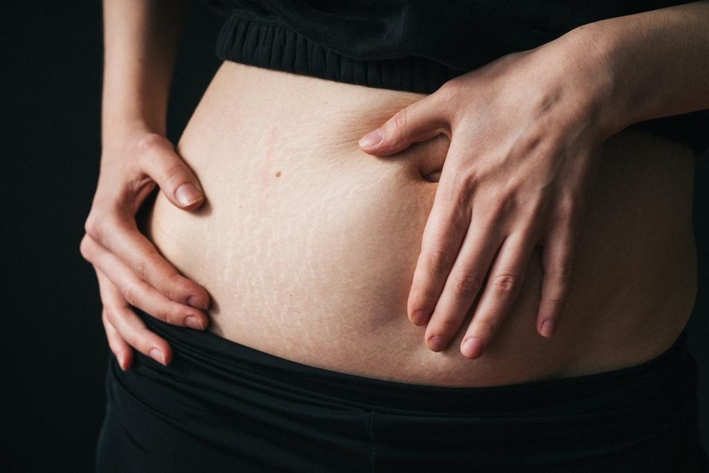Stretchmark