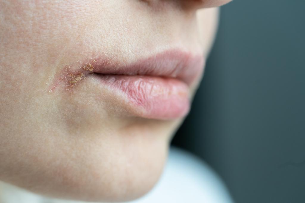 penyakit Herpes