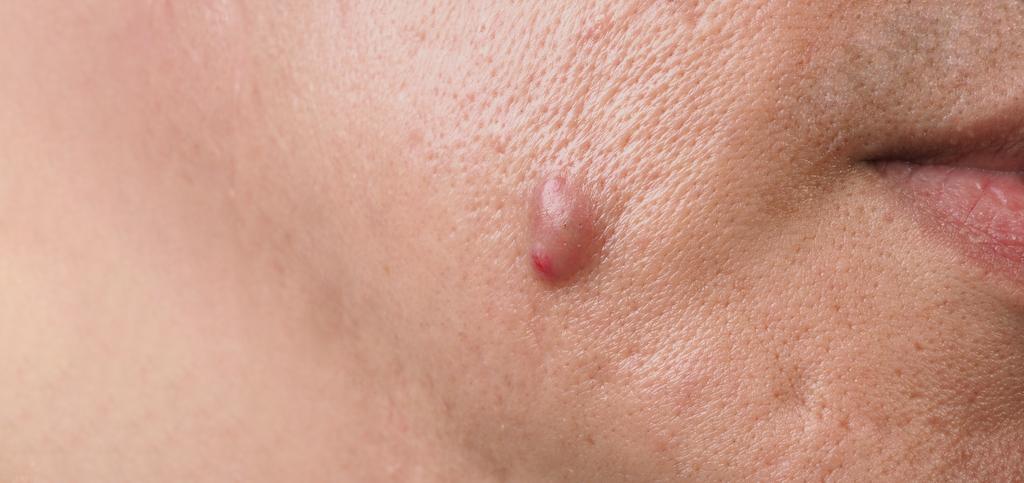 Apa itu Lipoma